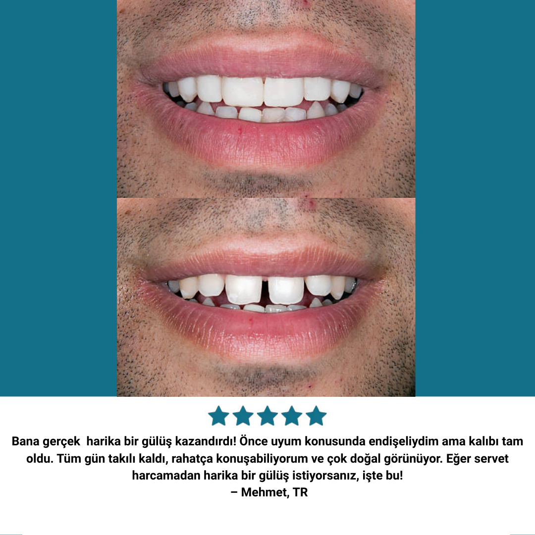 Glowdent™ Klipsli Kaplamalar