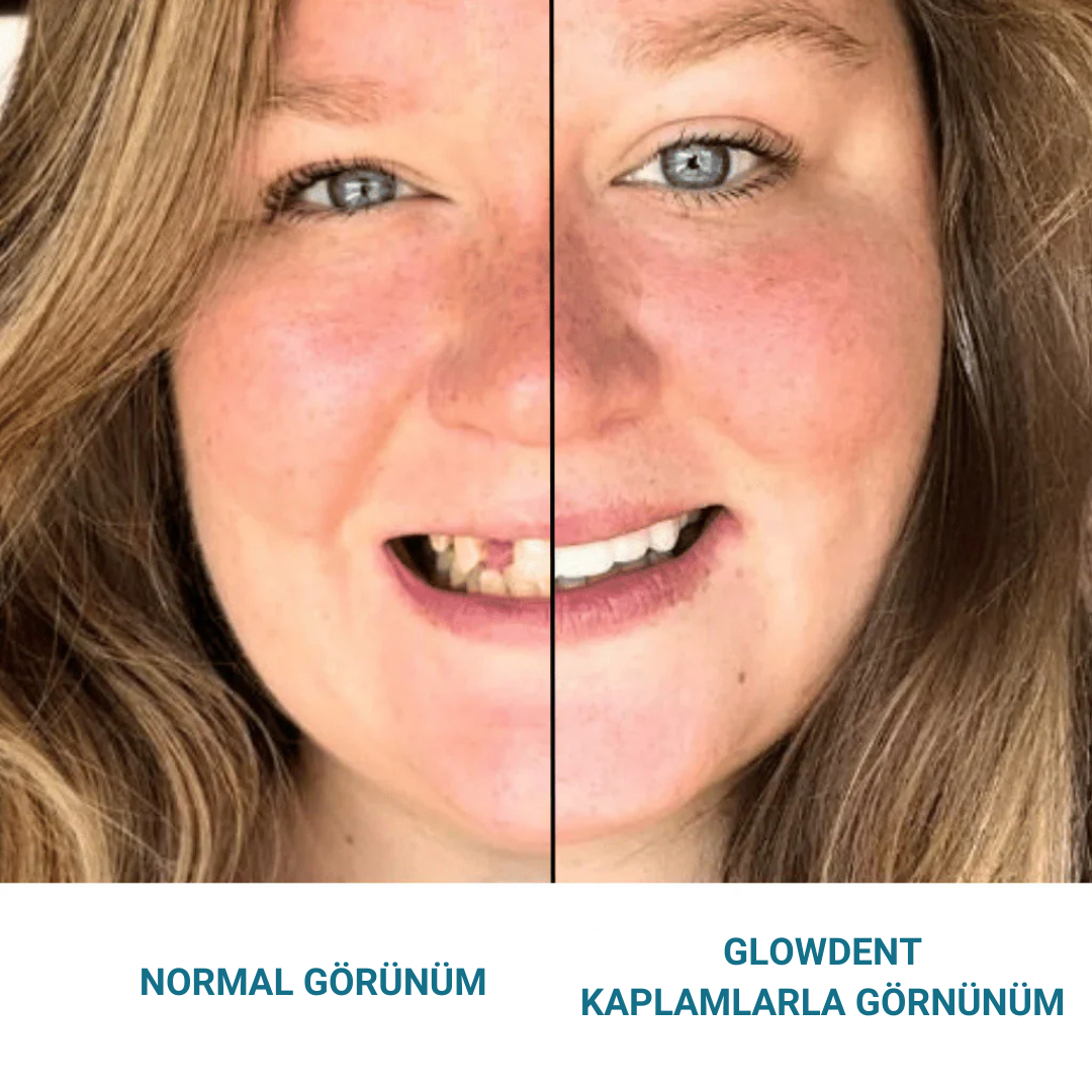 Glowdent™ Klipsli Kaplamalar